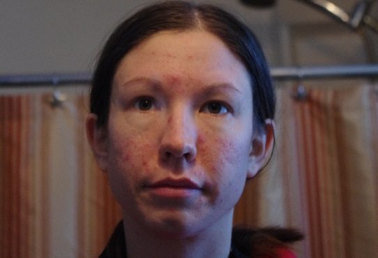 me with acne
