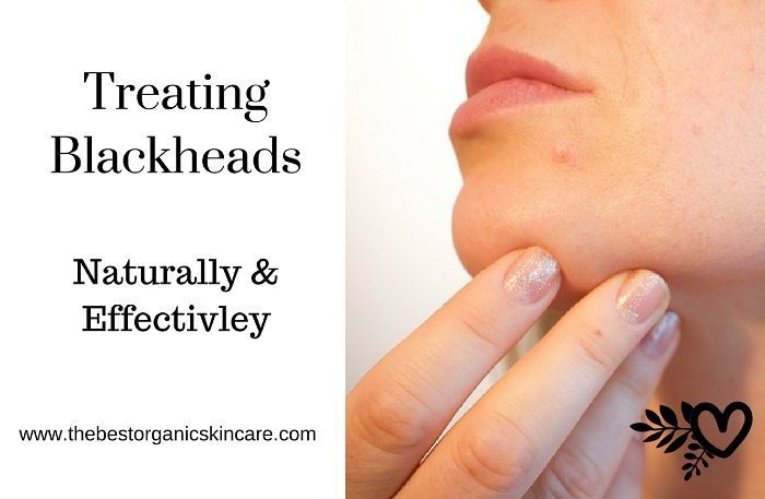 how to treat blackheads naturally