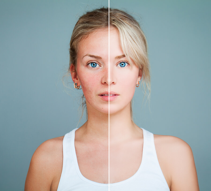 niacinamide for rosacea niacinamide for rosacea