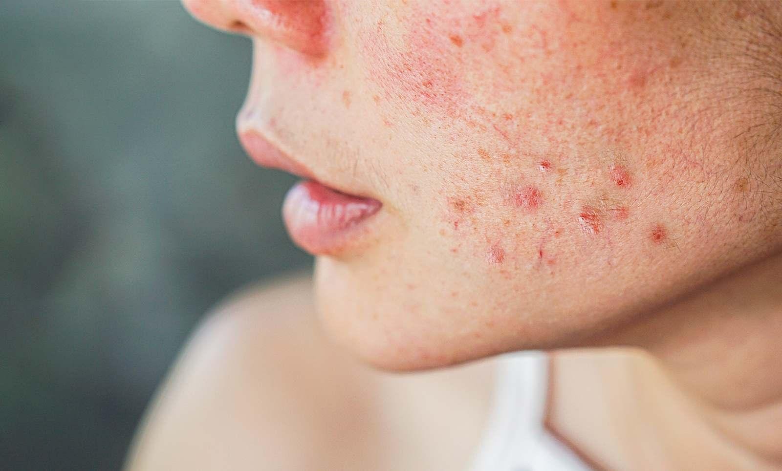 Apa Itu Skin Barrier